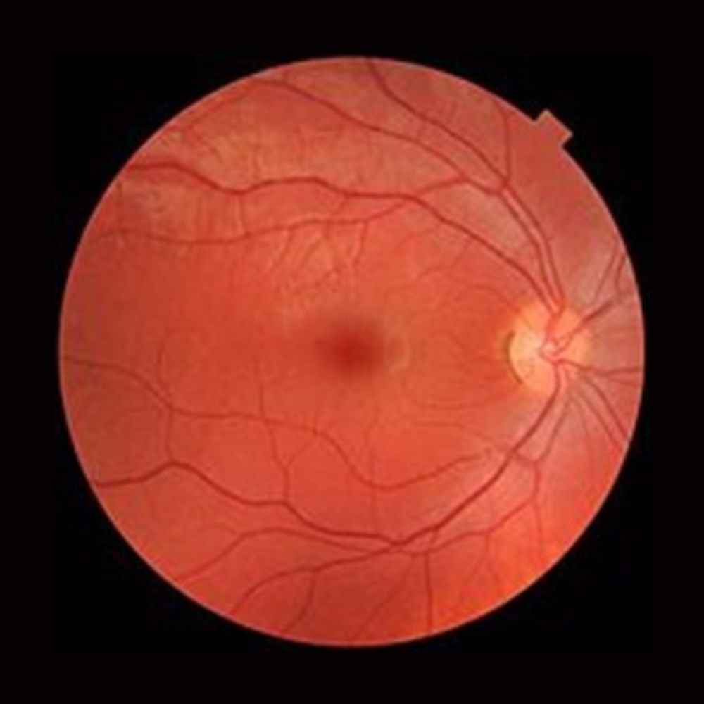 : Colour photograph of the back of the right eye. The pale region on the right is the optic nerve head. Blood vessels fan out from here across the retina. The background is a pink hue. The dark spot in the centre is the fovea, the area of maximum focus. This picture represents a healthy eye.